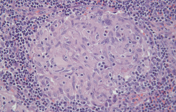 A non-caseating granuloma from mediastinal lymph node biopsy confirming sarcoidosis. H&E magnification x200. 