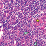 Regressed germinal center with follicular dendritic cell prominence (star), onion-skinning (blue arrowhead) and increased vascularity (orange arrows) are seen.