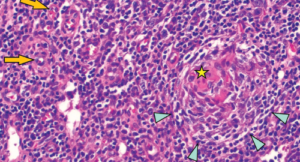 Regressed germinal center with follicular dendritic cell prominence (star), onion-skinning (blue arrowhead) and increased vascularity (orange arrows) are seen.