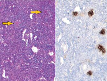 Figure 1: Vague nodular areas (orange arrows) on the left and CD21 staining for follicular dendritic cells on the right demonstrate follicles with regressed germinal centers.