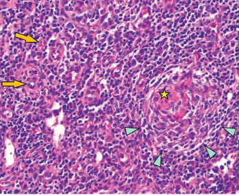 Figure 2: Regressed germinal center with follicular dendritic cell prominence (star), onion-skinning (blue arrowhead) and increased vascularity (orange arrows) are seen.