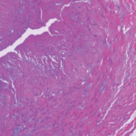 Atypical Giant Cell Arteritis Case Illustrates Diagnosis, Management Challenges