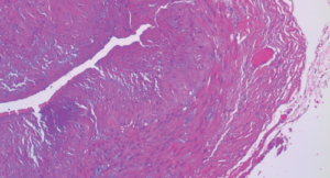Atypical Giant Cell Arteritis Case Illustrates Diagnosis, Management Challenges