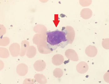 Peripheral blood smear showing a large granular lymphocyte in a 53-year-old Hispanic man.