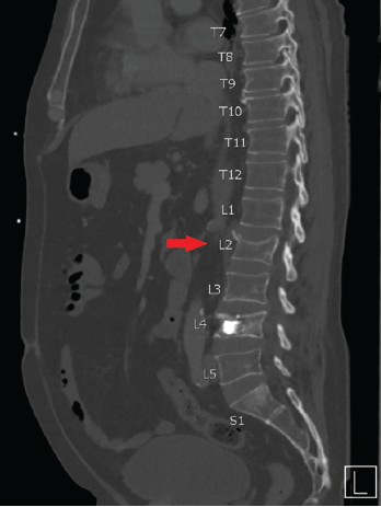 CT scan showing an incidental, non-traumatic L2 vertebral compression fracture.