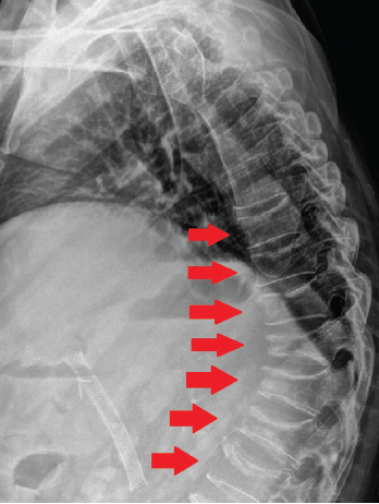 Plain radiograph of the thoracic and lumbar spine two months after discovery of the incidental L2 vertebral compression fracture on CT imaging. Shown here is a striking multilevel array of compression fractures involving T10–L5.