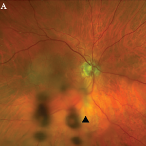 Optos Fundus photo of the right eye with subtle area of retinal whitening in the macula with mild vitreous opacities inferiorly (arrowhead).
