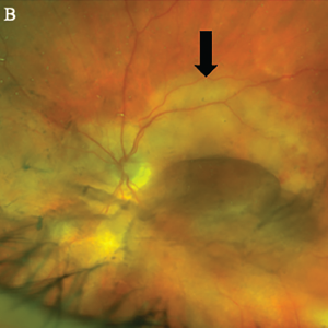 Optos Fundus photo of the left eye with large placoid area of retinal whitening involving the macula (arrow), with retinal hemorrhages and vitreous opacity temporally.