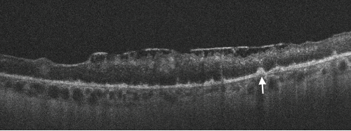 Spectral domain optical coherence tomography (SD-OCT) of the left eye with hyper-reflective retinal pigment epithelial (RPE) nodularity (white arrow) and overlying loss of normal photo receptor architecture.