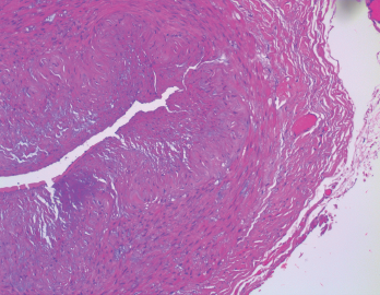 The biopsy of the right temporal artery with hematoxylin and eosin (H&E) staining was unremarkable.