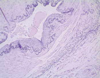 In the biopsy of the right temporal artery with elastin staining, the internal elastic lamina is preserved despite the appearance of artifactual interruptions in the internal elastic layer caused by specimen processing.