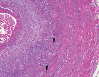 The biopsy of the left temporal artery with H&E staining shows multinucleated giant cells.