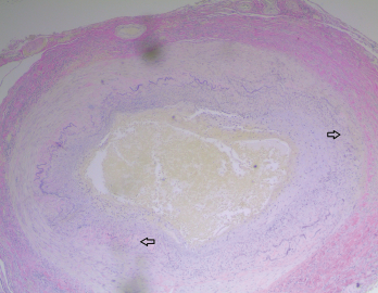 The biopsy of the left temporal artery with elastin staining shows disruption of the internal elastic lamina.