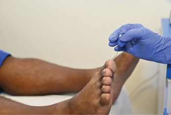 A monofilament test is being carried out on the foot of a 50-year-old male patient to test for nerve damage (neuropathy).