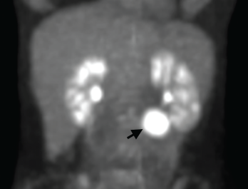 A positron emission tomography (PET) scan shows a 3 cm, hypermetabolic mass adjacent to the stomach.