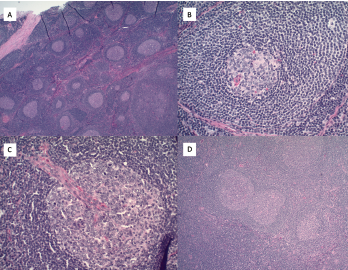 A) Hematoxylin and eosin stains at 2x magnification show follicular hyperplasia with hyperplastic germinal center and some regressed germinal centers; B) atretic follicle surrounded by expanded onion-skin mantle zone at 20x magnification; C) increased vascularity including perpendicularly penetrating vessels into follicles resulting in lollipop forms at 20x magnification; and D) twinning of germinal centers at 4x magnification. 