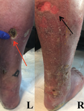 Figure 1: Lower Extremity Ulceration