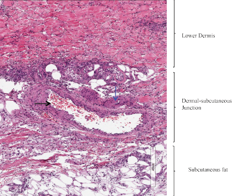 Figure 2: Skin Biopsy