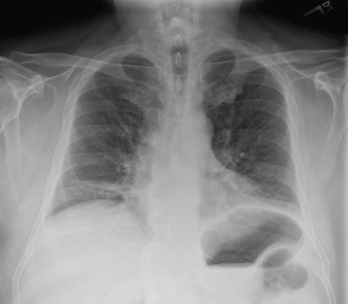Figure 3: Chest X-ray (Posteroanterior View)