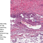 Medium-sized blood vessels are seen in the dermis and at the dermal-subcutaneous junction. The black arrow identifies a venule, and the blue arrow points to a fibrin deposition in the vessel wall. Extravasated neutrophils and erythrocytes are seen in the interstitium.