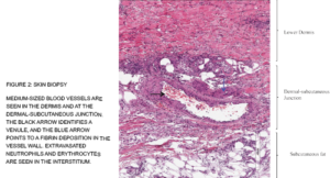 Medium-sized blood vessels are seen in the dermis and at the dermal-subcutaneous junction. The black arrow identifies a venule, and the blue arrow points to a fibrin deposition in the vessel wall. Extravasated neutrophils and erythrocytes are seen in the interstitium.