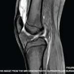 This image from the MRI demonstrates suprapatellar bursal fluid of mixed signal.