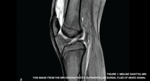 This image from the MRI demonstrates suprapatellar bursal fluid of mixed signal.