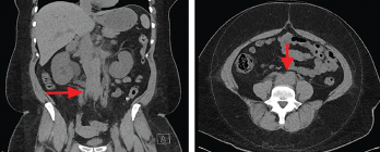 Computed tomography (CT) scan of the abdomen and pelvis (left panel: coronal view; right panel: axial view), without intravenous contrast administration, demonstrating increased retroperitoneal density around the aortic bifurcation (arrows).