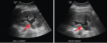 Figure Renal ultrasound, sagittal view, showing bilateral grade 2 hydronephrosis (arrows) with normal renal cortical thickness and without focal lesions or nephrolithiasis.