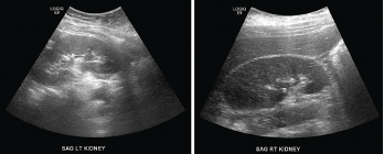 Renal ultrasound, sagittal view, performed a week after stenting showed complete resolution of hydronephrosis.