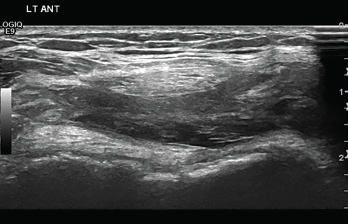 Figure 2: Transverse Ultrasound of the Anterior Knee