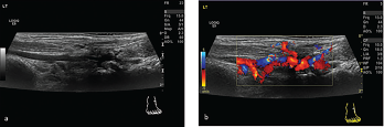 Figures 3A & 3B: Ultrasound