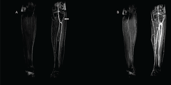 Figures 4A & 4B: Contrast-Enhanced MRI