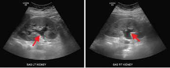 Renal ultrasound, sagittal view, showing mild bilateral hydronephrosis (arrows) with expansion of the renal sinus and calyces with normal renal cortical thickness and echogenicity.