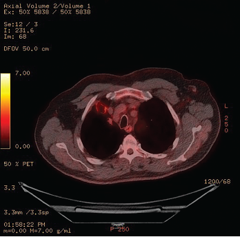 Figure 2: 18F-fluorodeoxyglucose PET/CT Scintigraphy