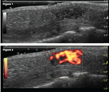 A longitudinal scan of the nodule on the volar aspect of the DIP joint revealed an ill-defined hypoechoic lesion on gray scale (Fig. 1), with power Doppler activity filling the lesion (PRF 500–1000 Hz; Fig. 2).