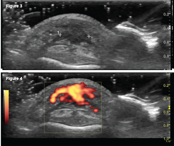 A transverse scan of the nodule on the volar aspect of the DIP joint revealed an ill-defined hypoechoic lesion on gray scale (Fig. 3), with power Doppler activity filling the lesion (PRF 500–1000 Hz; Fig. 4).