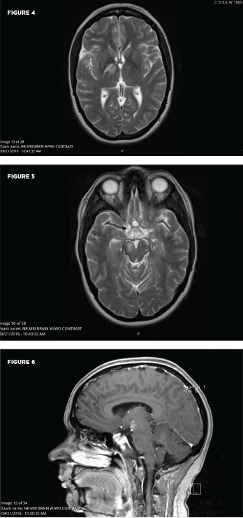 These MRI scans reveal new signal abnormality and enhancement in the bilateral internal capsules, extending into the brainstem. 