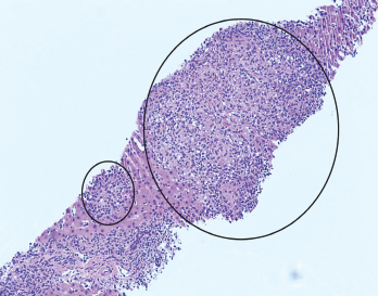 H&E stain at 100X showing granulomas accompanied by scattered admixed lymphocytes.