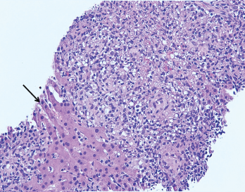 The image from Figure 1 at 200X showing granulomas accompanied by scattered admixed lymphocytes without discernible atypia. Adjacent hepatocytes (black arrow), polygonal cells with centrally placed nucleus and eosinophilic cytoplasm, can also be identified.