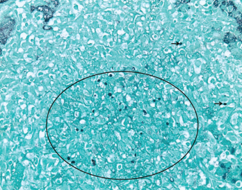 GMS (Grocott’s methenamine silver stain) at 400X highlights scattered yeast forms (black circle and black arrows) morphologically consistent with Histoplasma capsulatum.