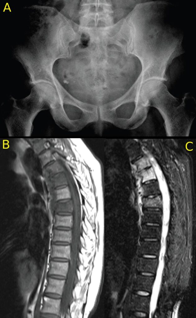Imaging of Axial Psoriatic Arthritis The Rheumatologist