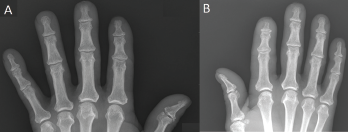 Acro-osteolysis with resorptive changes of the tufts of the distal phalanges of (A) the left first, second and third digits, and (B) the right second and third digits. 