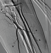 Invasive angiogram of left brachial artery terminating into the radial and ulnar arteries. Note the multiple corkscrew collateral vessels off the radial and ulnar arteries (arrowheads).