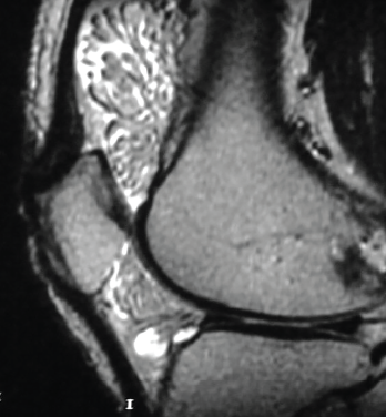 The MRI shows lipoma arborescens of the knee.
