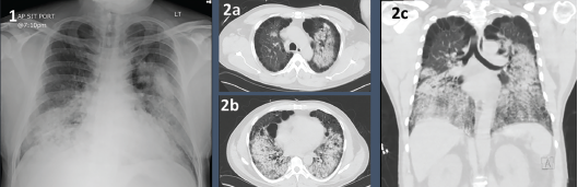 Figure 1: Chest X-ray with bilateral airway opacities. Figure 2A–C: Chest CT showing extensive bilateral upper and lower lobe airway disease. 