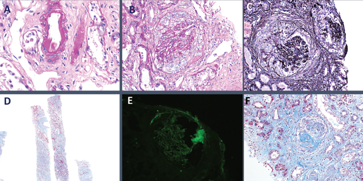 Figure 3: Histopathology from kidney biopsy