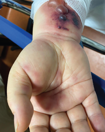 Tense hemorrhagic bullae developed over the course of the patient’s disease. Tender purpuric papules on the palms and marked hand swelling are also apparent.