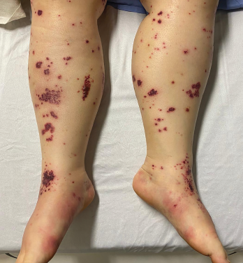 The patient had palpable purpura and hemorrhagic vesicles of both legs, with tender erythematous plaques and swelling over the feet. 