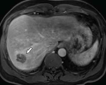 Axial CT of the liver, with the hepatic lobe abscess indicated by the arrow.